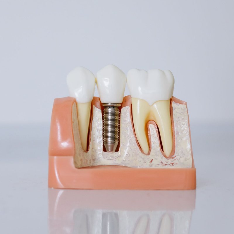 Anatomical model of a dental implant