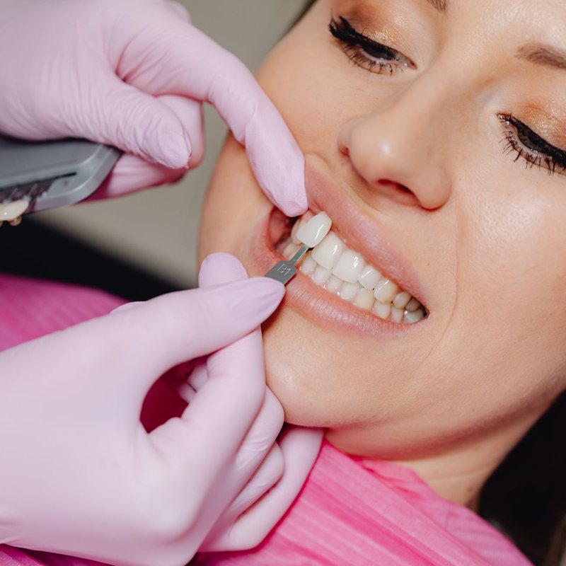 Close-up of veneer shade matching at a dental clinic